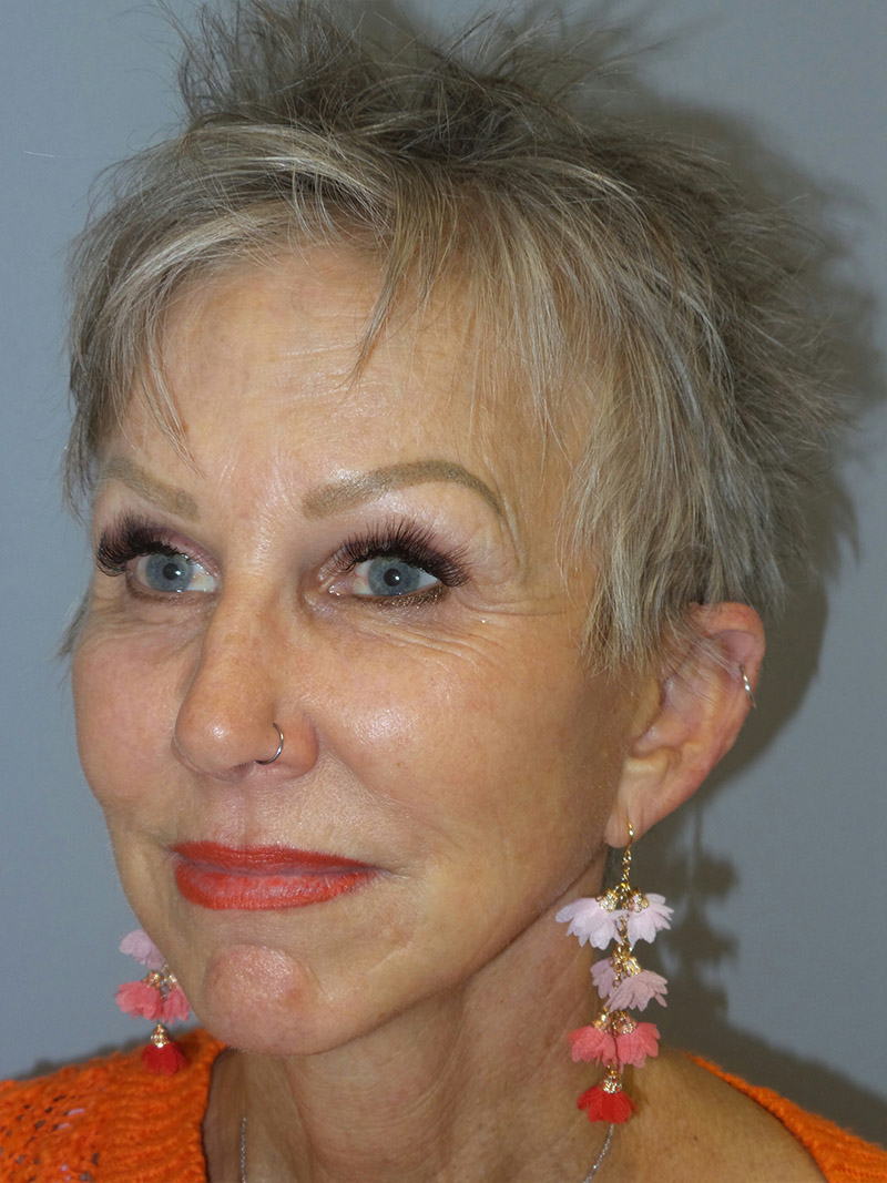 Facelift Before and After 09 | Grover Aesthetics