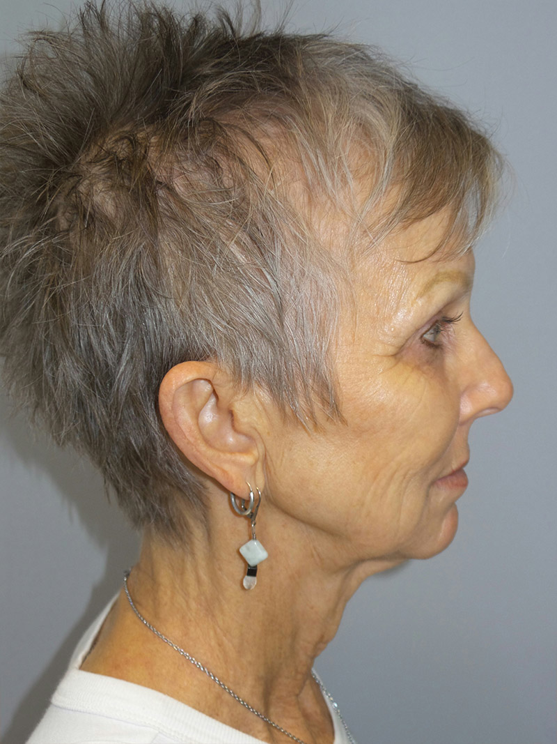 Facelift Before and After 09 | Sanjay Grover MD FACS