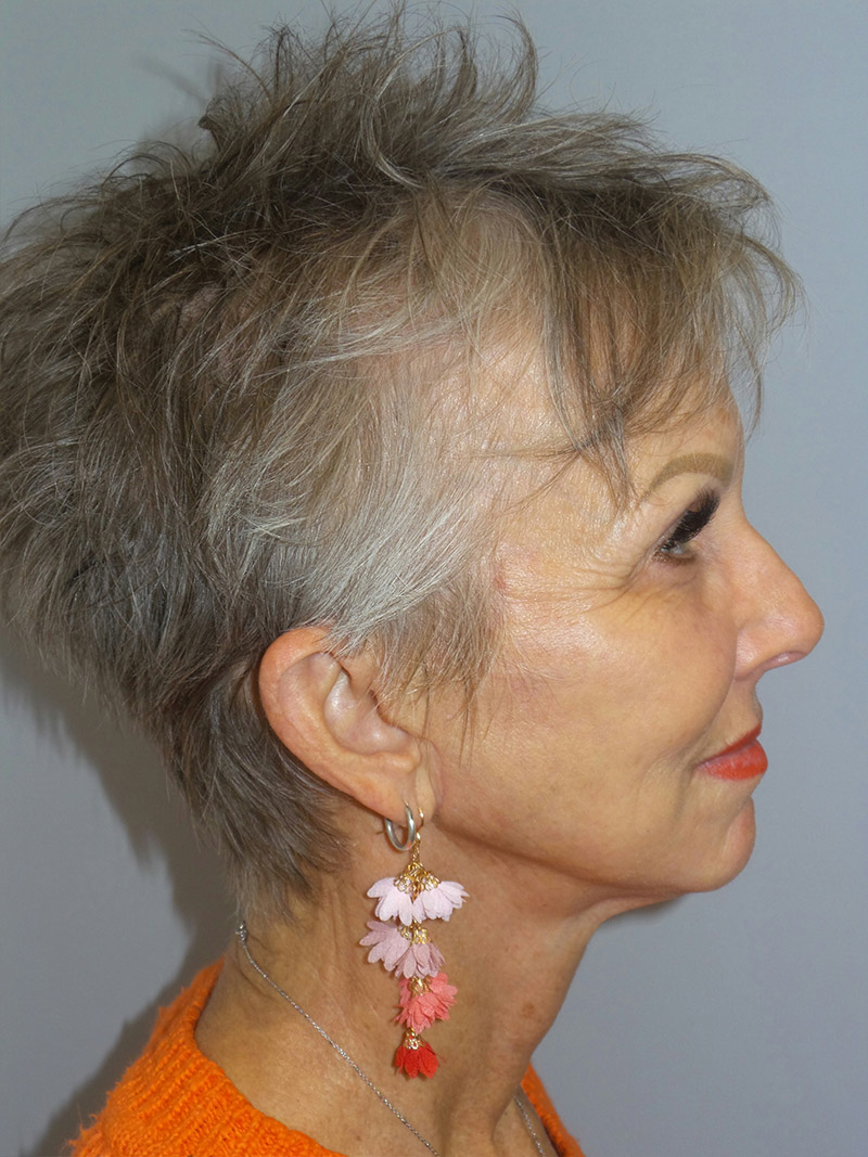 Facelift Before and After 09 | Sanjay Grover MD FACS