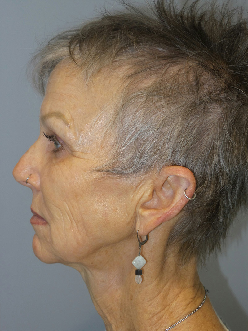 Facelift Before and After 09 | Sanjay Grover MD FACS