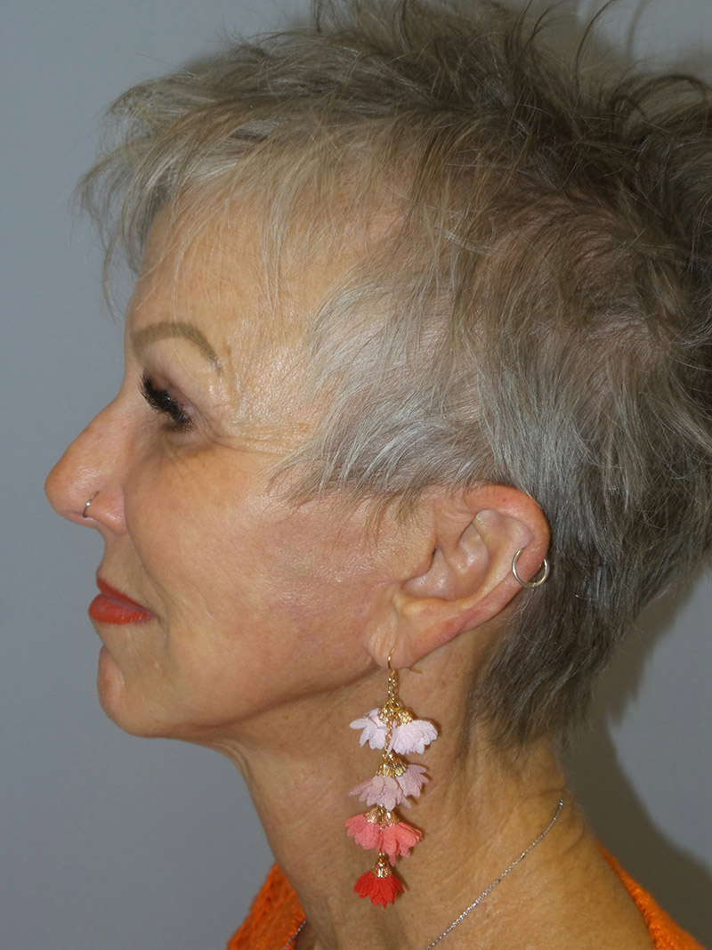 Facelift Before and After 09 | Grover Aesthetics