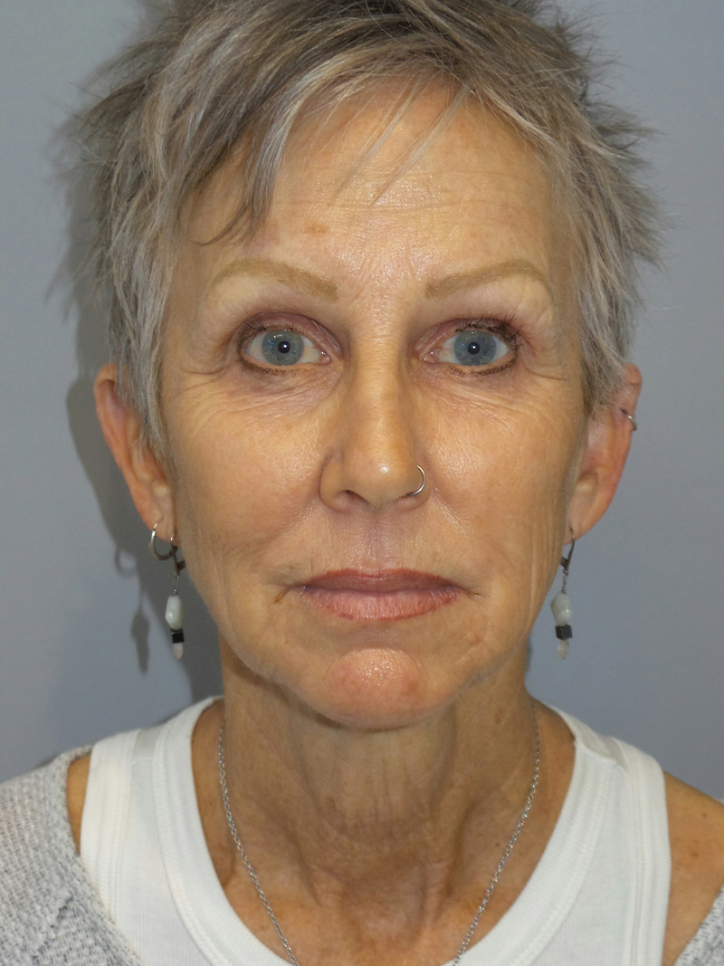 Facelift Before and After 09 | Grover Aesthetics