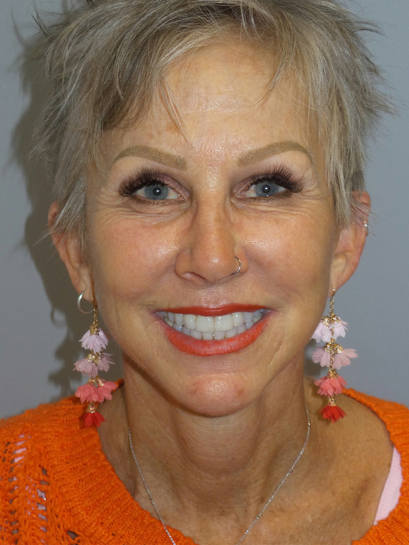 Facelift Before and After 09 | Grover Aesthetics