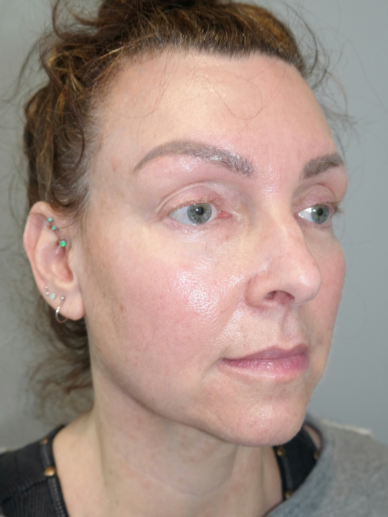 Facelift Before and After 01 | Sanjay Grover MD FACS