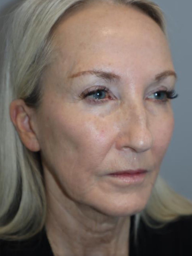 Facelift Before and After 28 | Sanjay Grover MD FACS