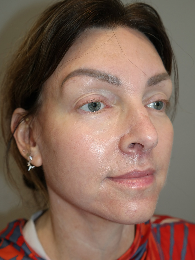 Facelift Before and After 10 | Sanjay Grover MD FACS