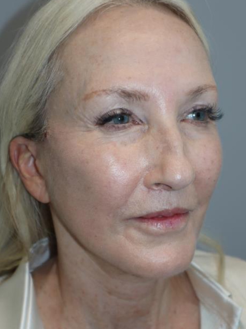 Facelift Before and After 10 | Sanjay Grover MD FACS