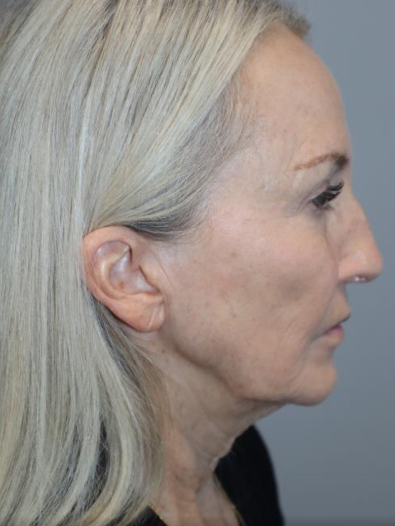 Facelift Before and After 10 | Sanjay Grover MD FACS