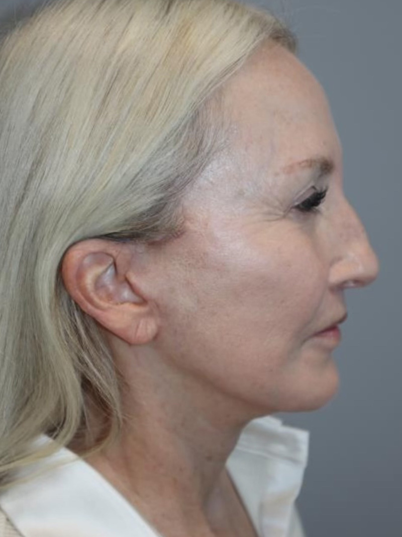 Facelift Before and After 10 | Sanjay Grover MD FACS