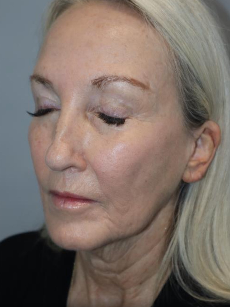 Facelift Before and After 10 | Sanjay Grover MD FACS