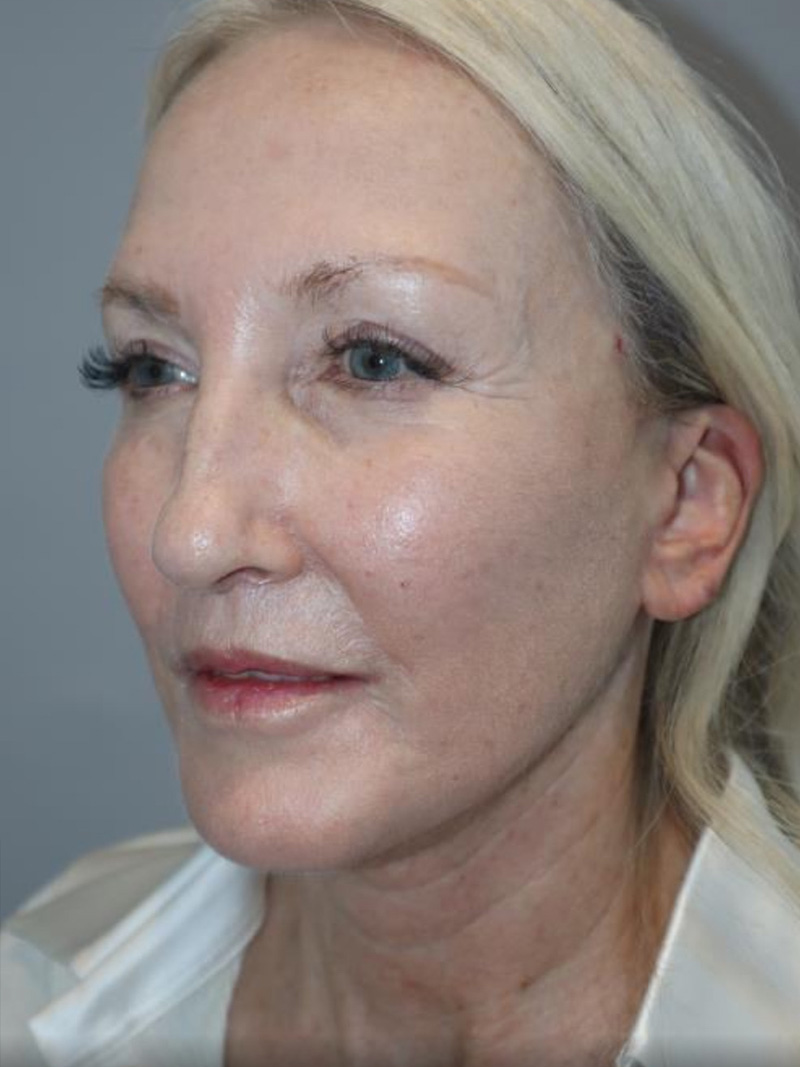 Facelift Before and After 10 | Sanjay Grover MD FACS