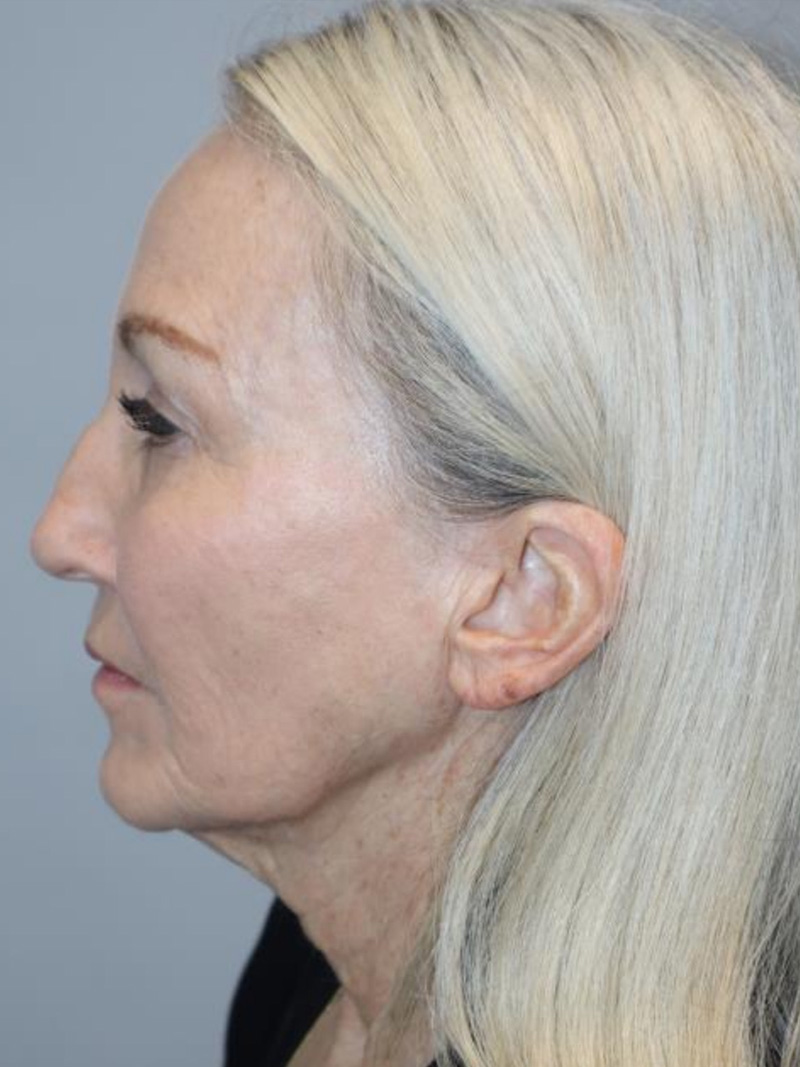 Facelift Before and After 10 | Sanjay Grover MD FACS