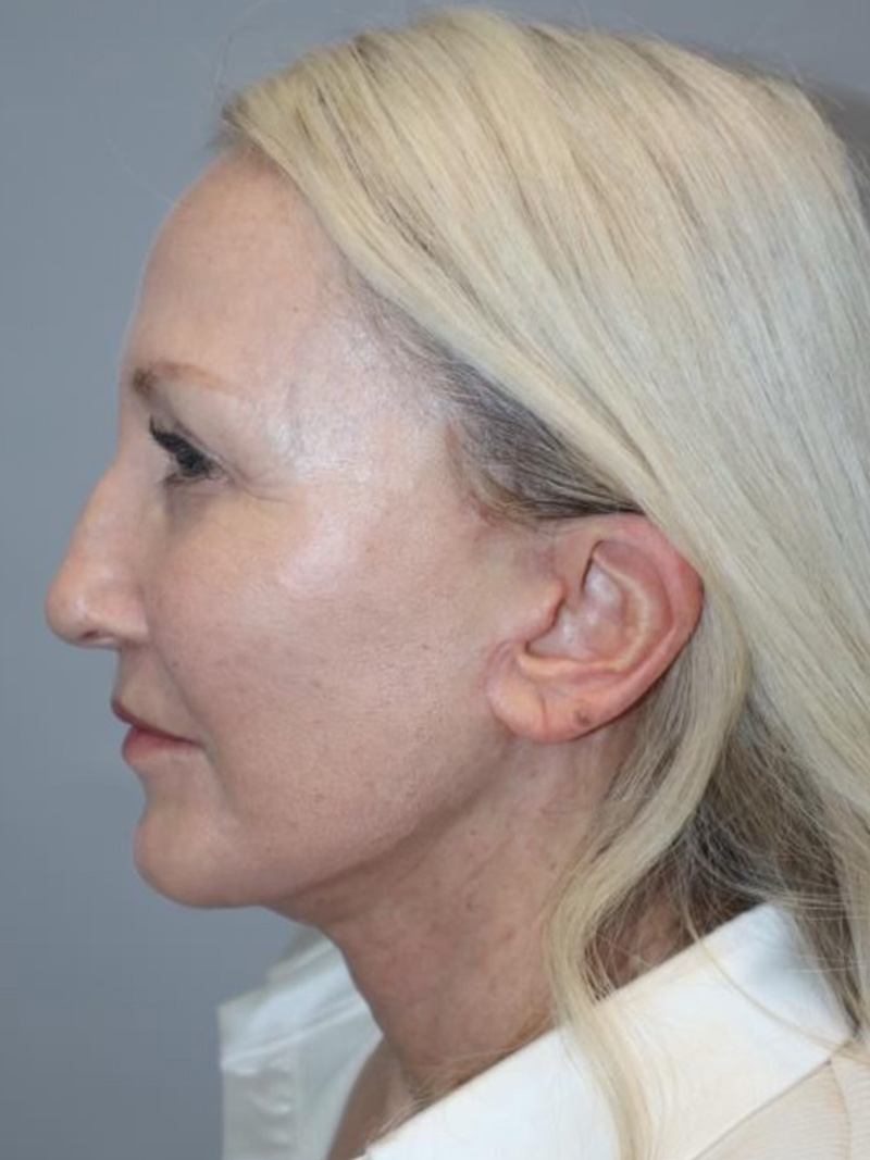 Facelift Before and After 10 | Sanjay Grover MD FACS