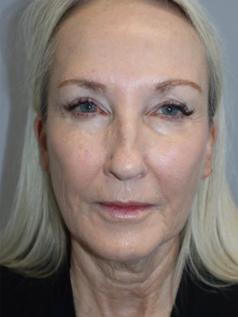 Facelift Before and After 10 | Sanjay Grover MD FACS