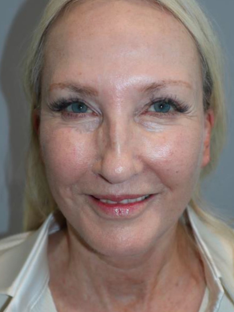 Facelift Before and After 10 | Sanjay Grover MD FACS