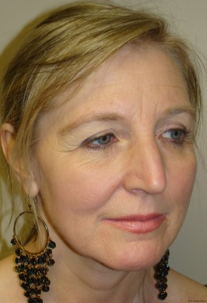 Facelift Before and After | Grover Aesthetics