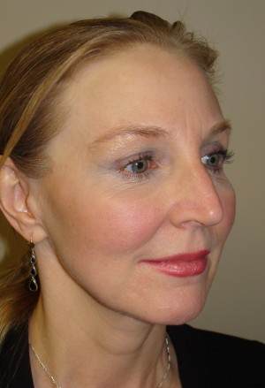 Facelift Before and After 11 | Sanjay Grover MD FACS