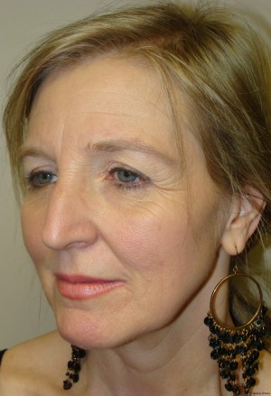 Facelift Before and After 11 | Grover Aesthetics
