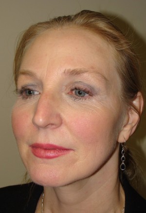 Facelift Before and After 11 | Sanjay Grover MD FACS