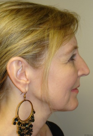 Facelift Before and After 11 | Grover Aesthetics