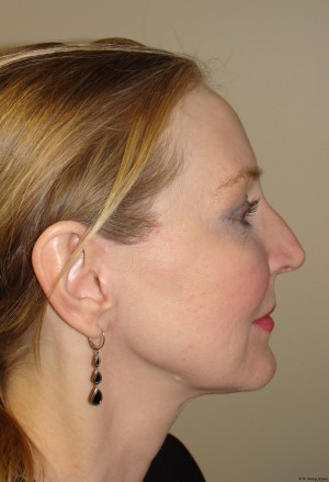 Facelift Before and After 11 | Grover Aesthetics