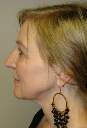 Facelift Before and After 11 | Sanjay Grover MD FACS