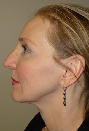 Facelift Before and After 11 | Grover Aesthetics