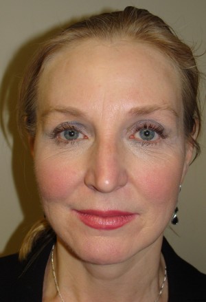 Facelift Before and After 11 | Grover Aesthetics