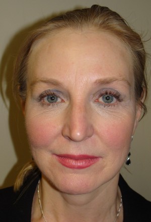 Facelift Before and After 11 | Sanjay Grover MD FACS