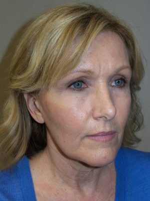 Facelift Before and After 04 | Sanjay Grover MD FACS