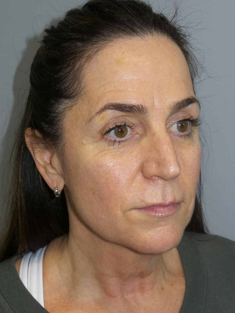 Facelift Before and After 34 | Sanjay Grover MD FACS