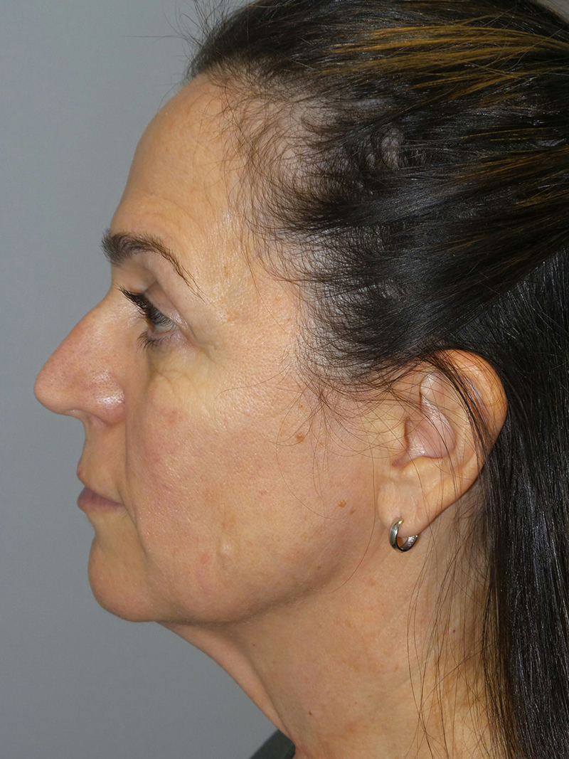 Facelift Before and After 12 | Sanjay Grover MD FACS