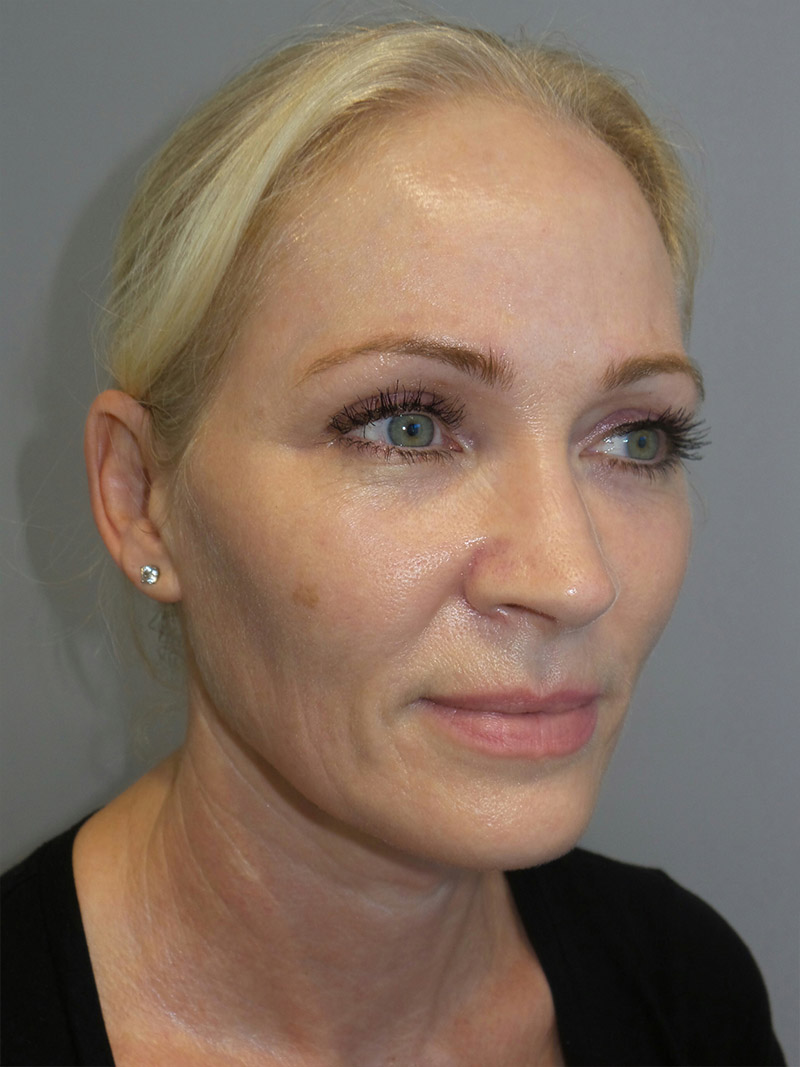 Facelift Before and After | Grover Aesthetics