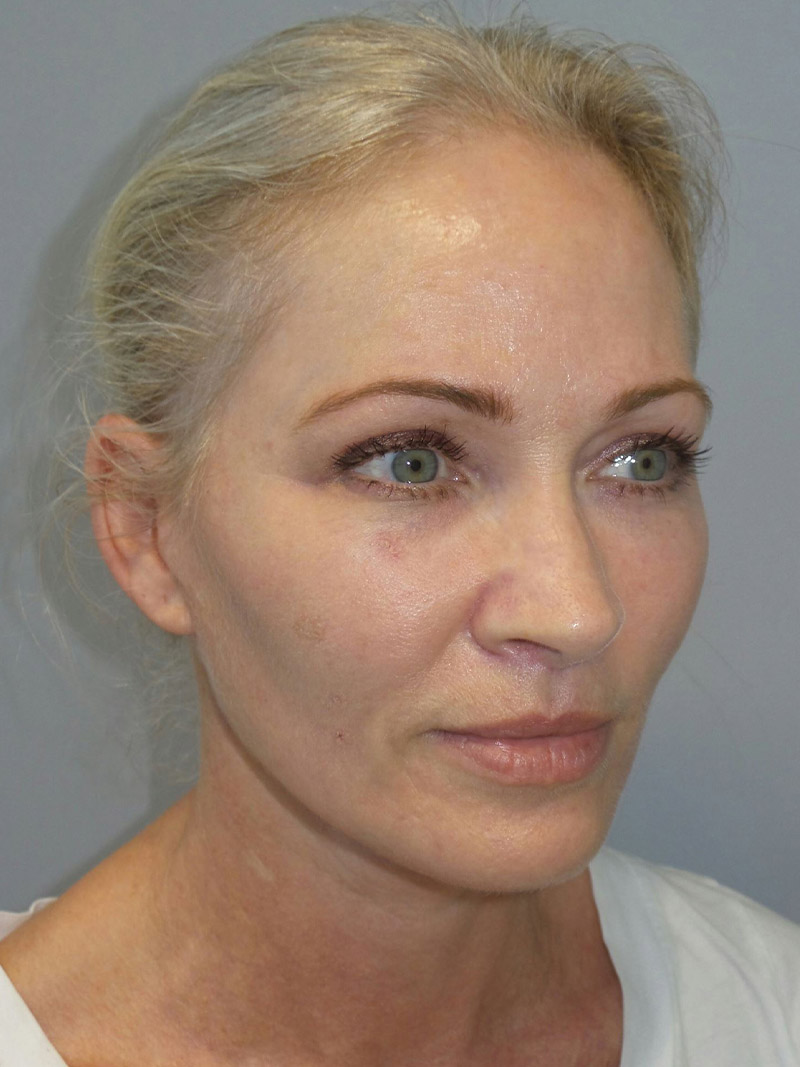 Facelift Before and After 13 | Sanjay Grover MD FACS