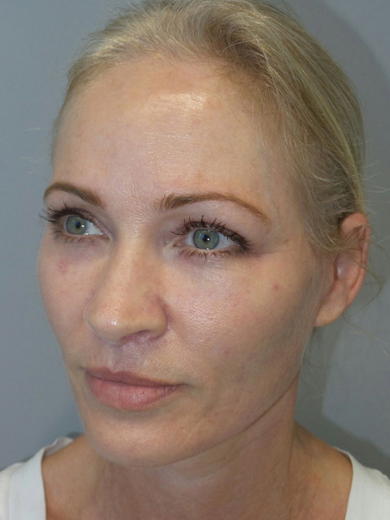 Facelift Before and After 13 | Sanjay Grover MD FACS