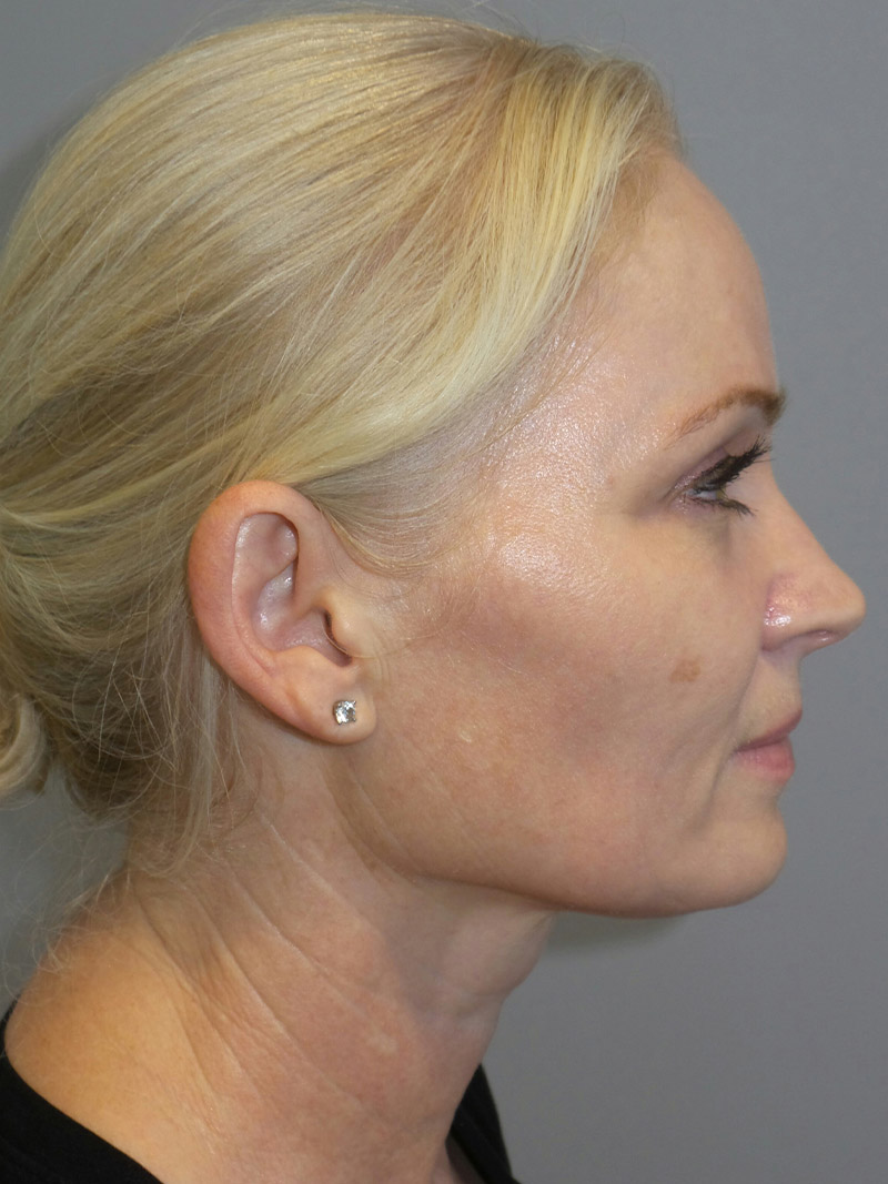 Facelift Before and After 13 | Sanjay Grover MD FACS