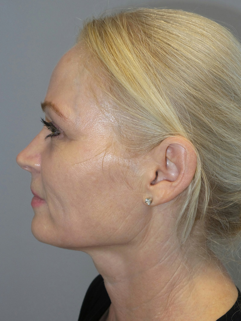 Facelift Before and After 13 | Sanjay Grover MD FACS