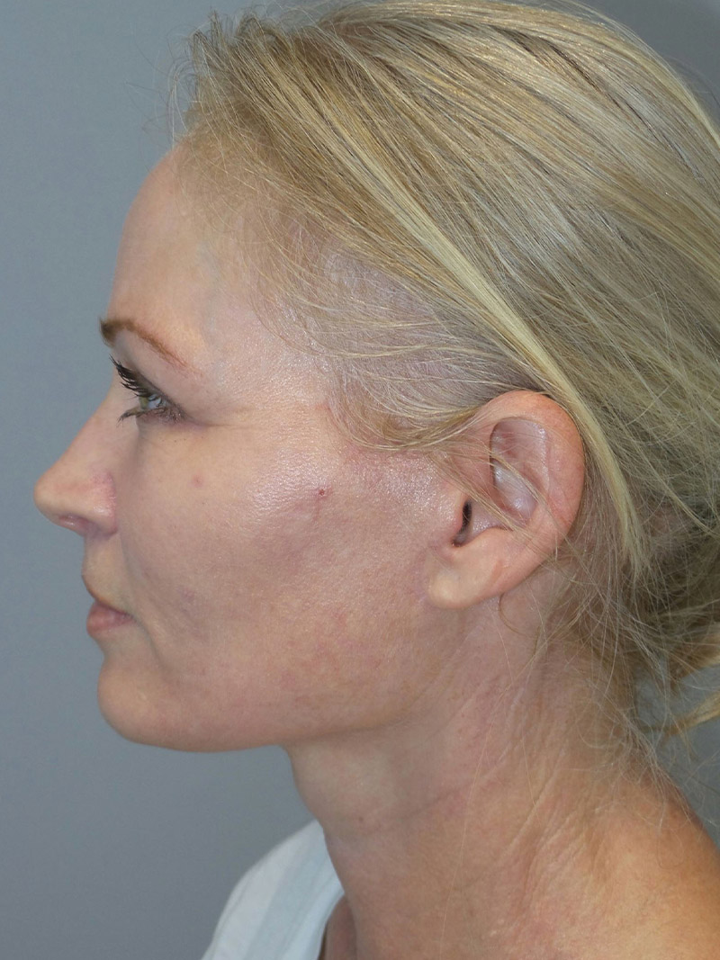 Facelift Before and After 13 | Sanjay Grover MD FACS