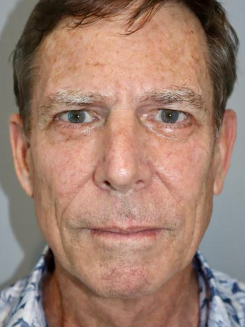 Facelift Before and After | Grover Aesthetics