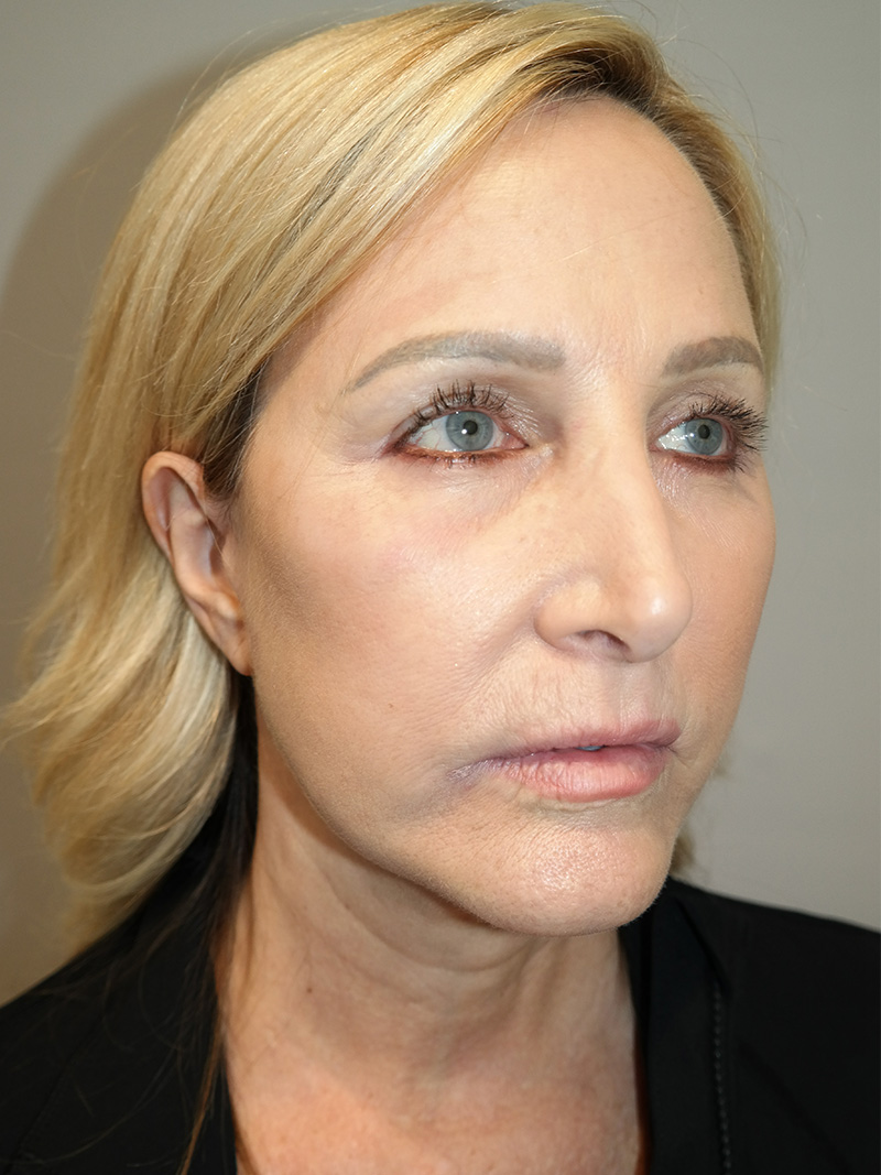 Facelift Before and After 15 | Sanjay Grover MD FACS