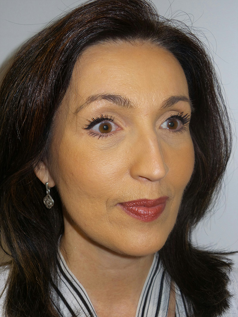 Facelift Before and After | Grover Aesthetics