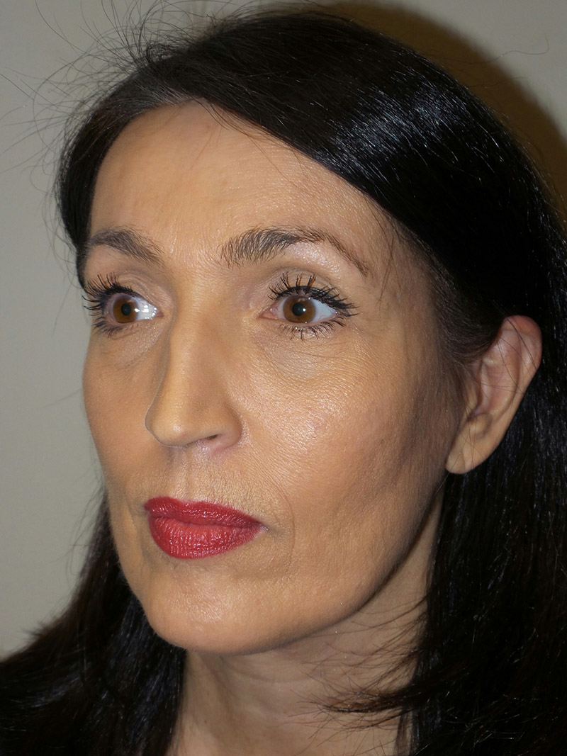 Facelift Before and After 15 | Sanjay Grover MD FACS