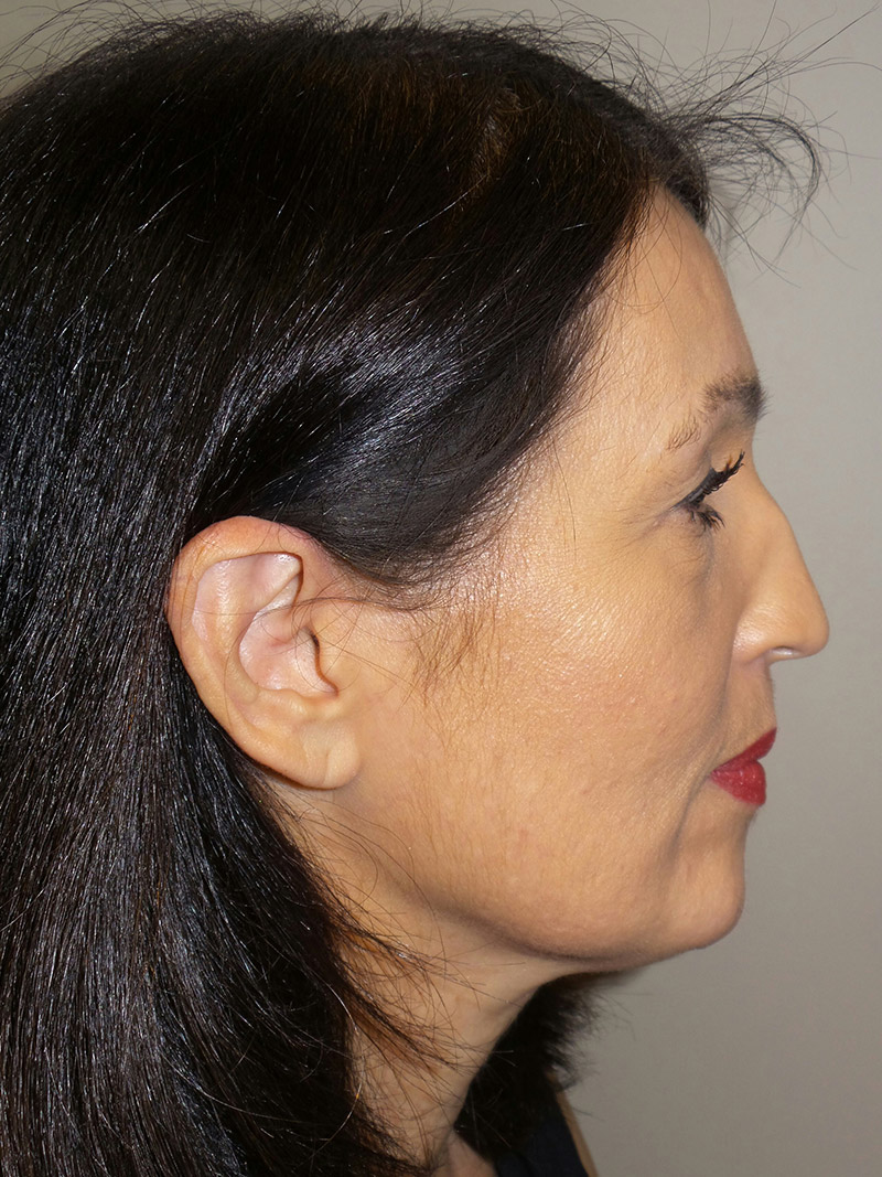 Facelift Before and After 15 | Sanjay Grover MD FACS