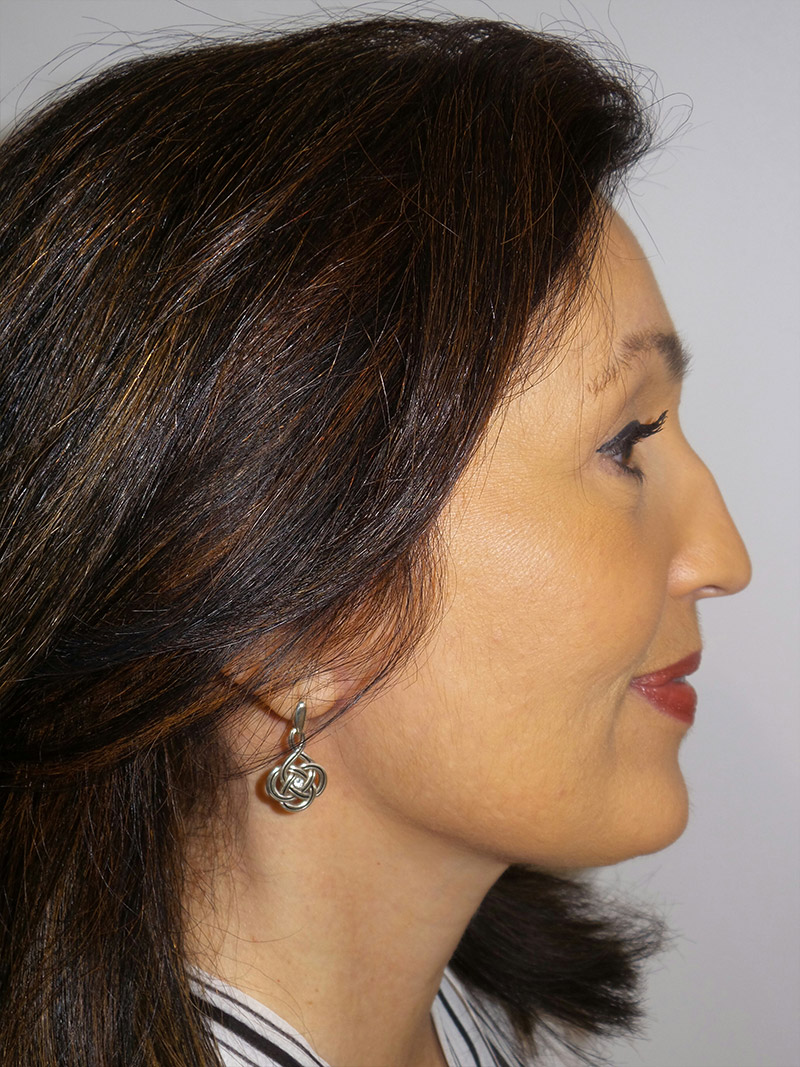 Facelift Before and After 15 | Sanjay Grover MD FACS