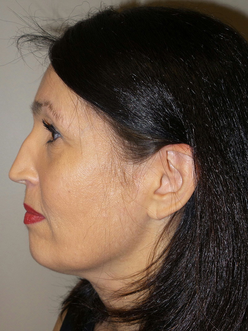 Facelift Before and After 15 | Sanjay Grover MD FACS