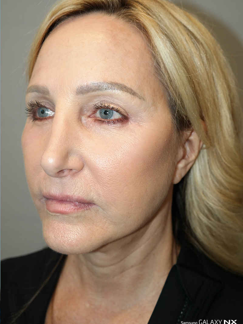 Facelift Before and After 15 | Sanjay Grover MD FACS
