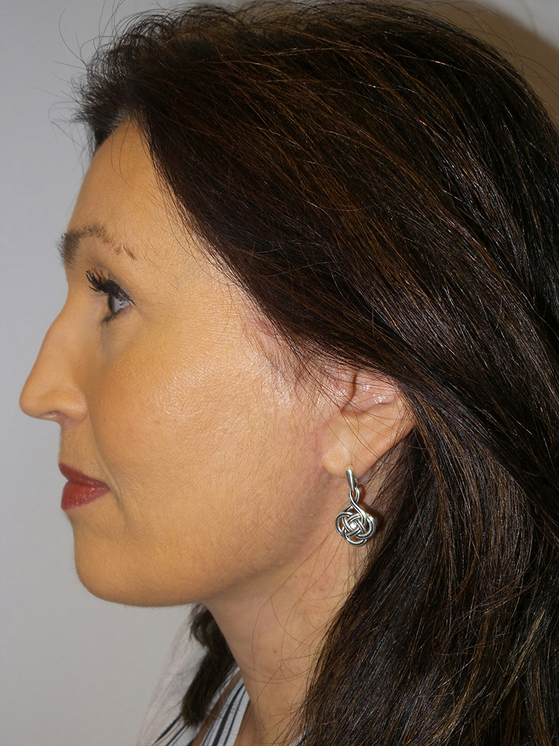 Facelift Before and After 15 | Sanjay Grover MD FACS