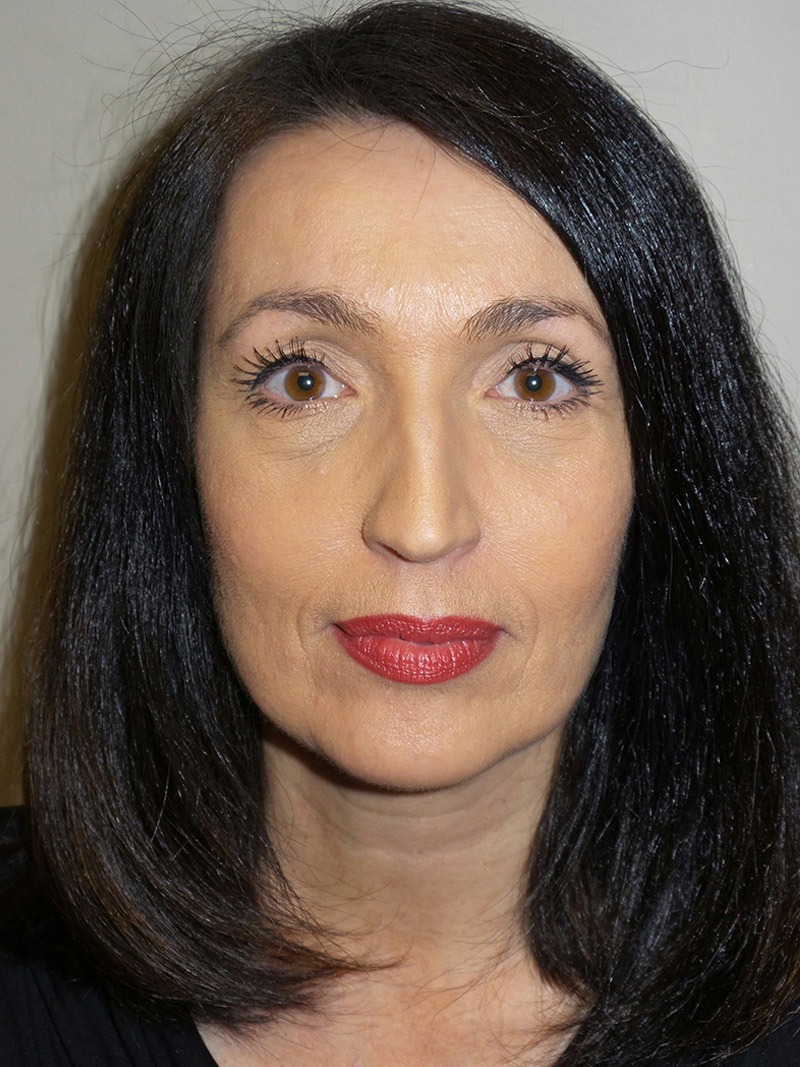 Facelift Before and After 15 | Grover Aesthetics