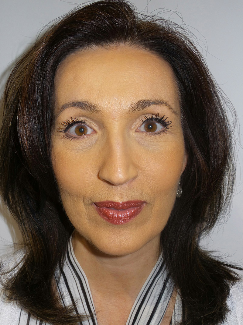 Facelift Before and After 15 | Sanjay Grover MD FACS