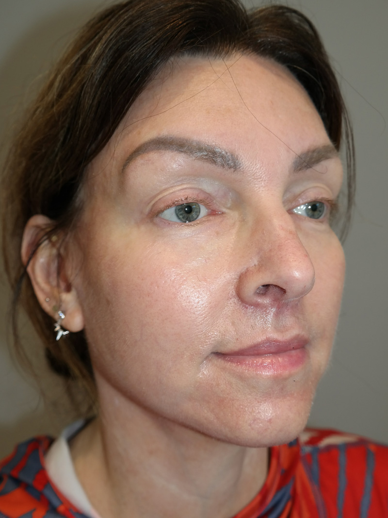 Facelift Before and After 16 | Sanjay Grover MD FACS